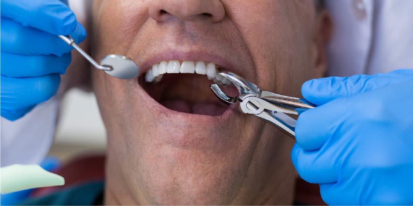 Dental Extraction-01